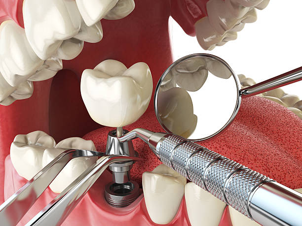 Best Chipped Tooth Repair Near Me  in Mabton, WA