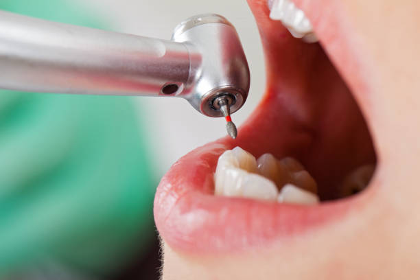 Best Chipped Tooth Repair Near Me  in Mabton, WA
